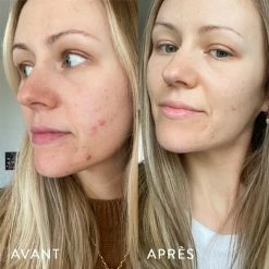 Microbiote & Peau -L:A Bruket Soldes AVANT APRES LAURA.1.4jpg